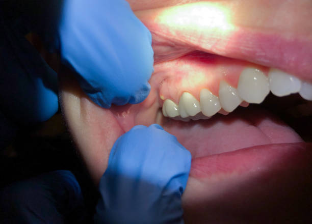 Best Knocked-Out Tooth Emergency  in Preston, TX